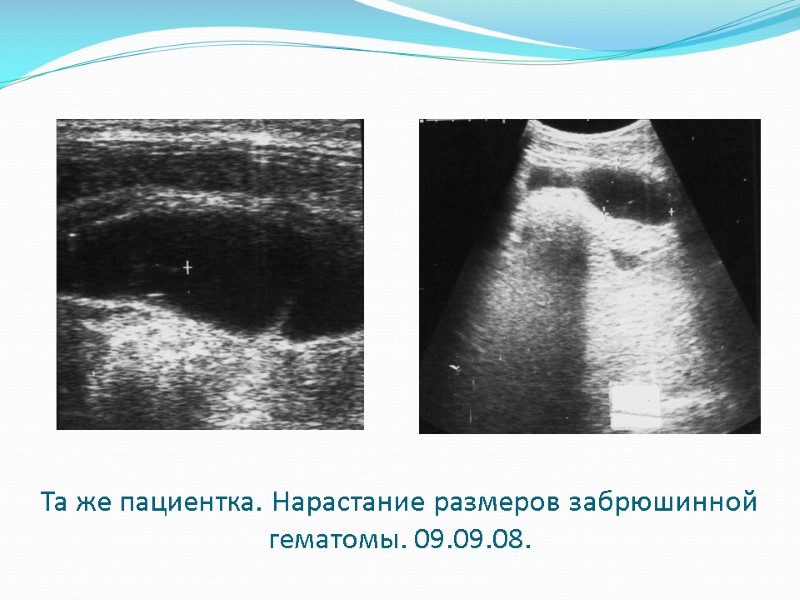 Та же пациентка. Нарастание размеров забрюшинной гематомы. 09.09.08.